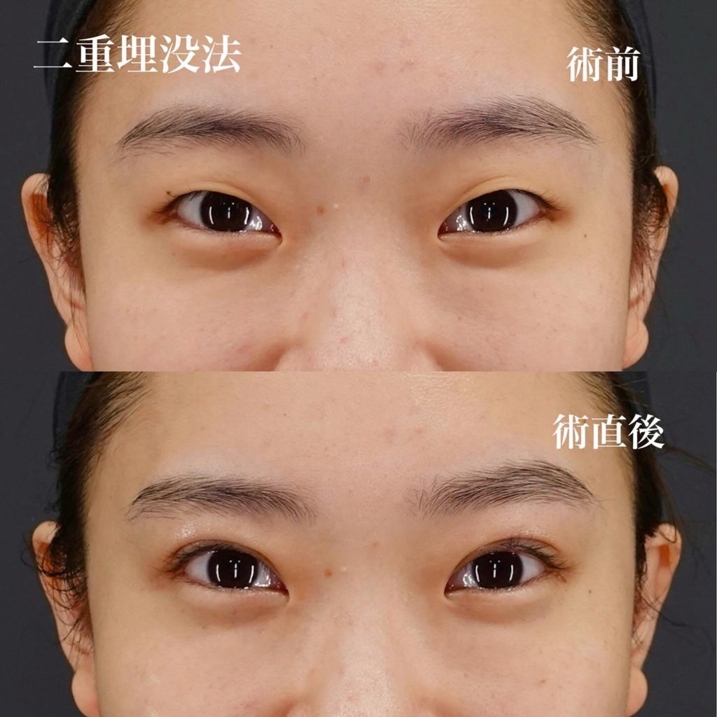 アイプチの雰囲気を残したい！