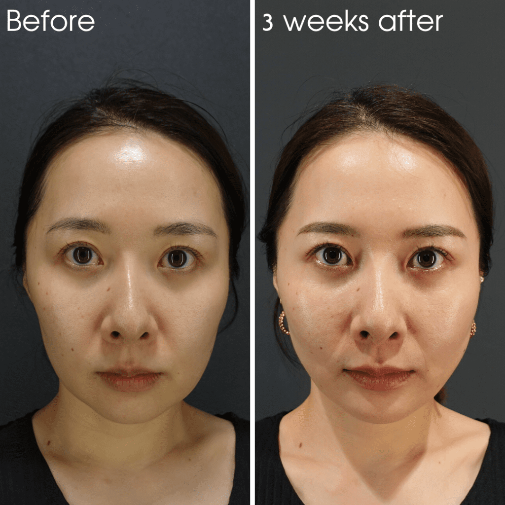 糸リフトは意味ない？アルテミスリフト3週間後の変化を公開【医師解説】