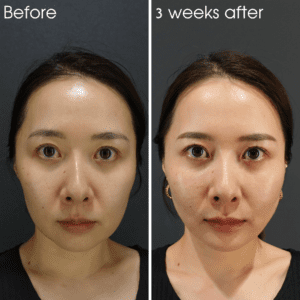 糸リフトは意味ない？アルテミスリフト（糸リフト症例写真・ビフォーアフター）