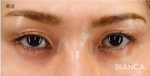 眼瞼下垂切開法の症例写真（術前）