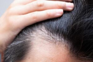 AGA治療の最前線|“抜け毛を止める”から“育てる”時代へ。幹細胞注射・ペプチド療法・ターゲットクール・プルリアルを解説【ビアンカクリニック】