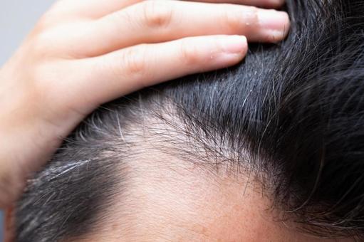 AGA治療・薬の最前線｜“抜け毛を止める”から“育てる”時代へ。幹細胞注射・ペプチド療法・ターゲットクール・プルリアルを解説【ビアンカクリニック】