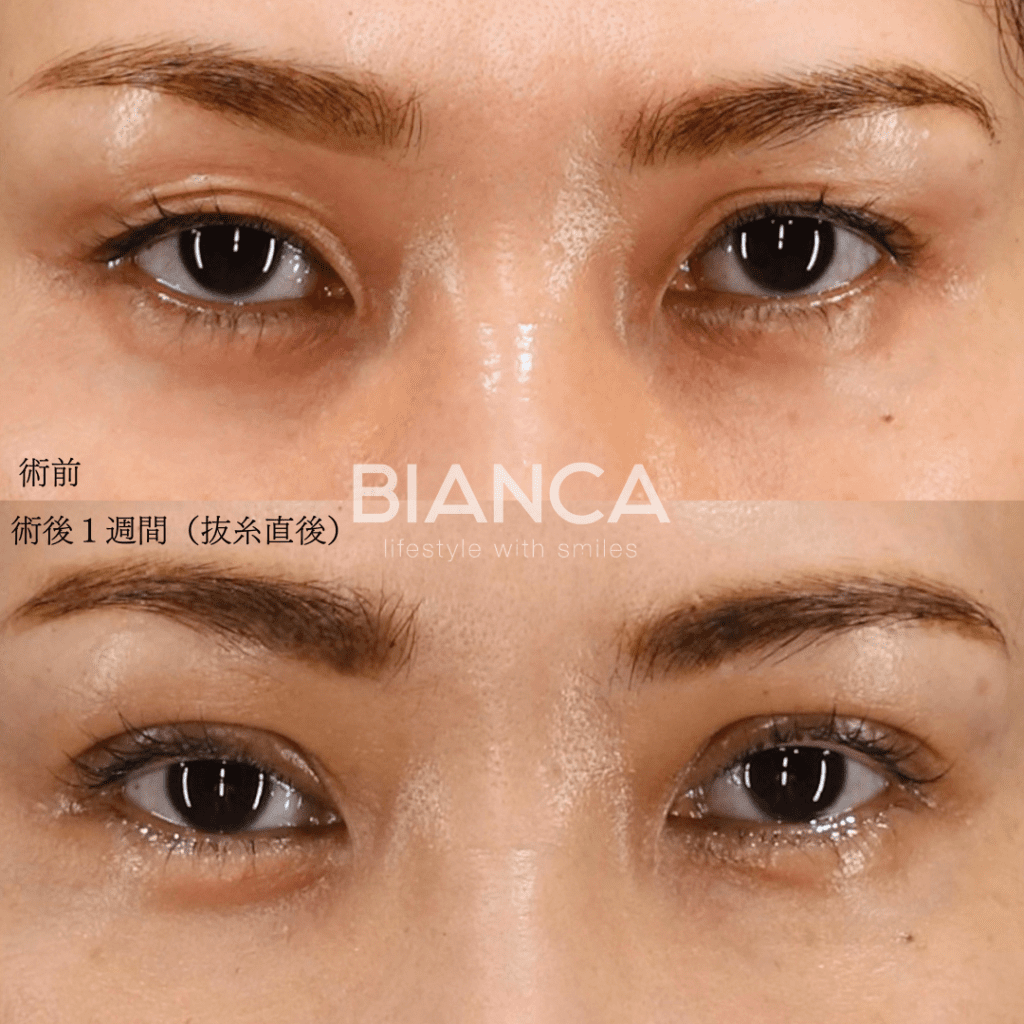 目が左右非対称なのが気になる…眼瞼下垂切開法の術後１週間までを公開