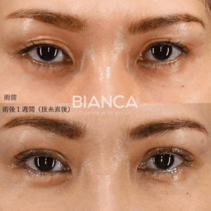 眼瞼下垂切開法の症例写真