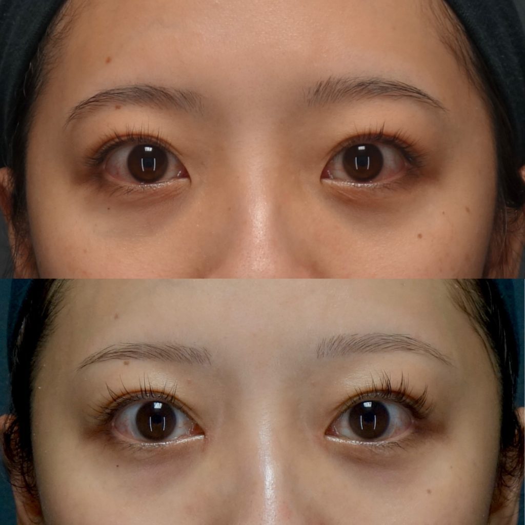 目の幅が狭い！目頭切開・目尻切開・グラマラスライン形成どれを選んだらいい？