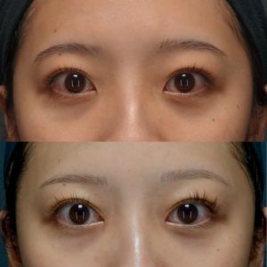 目頭切開の症例写真
