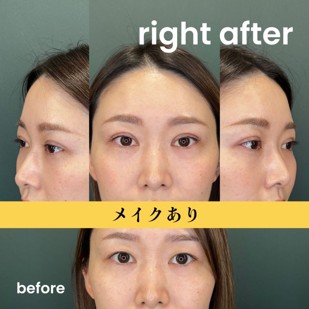 【アイプチでまぶたが伸びる？】自然で美しい二重をつくる方法と埋没のベストタイミング｜BIANCA CLINIC 池田雪太郎医師監修