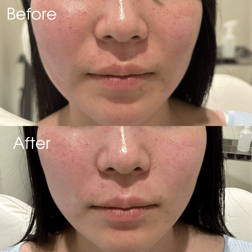 貴族ヒアルとは？ほうれい線ヒアルとの違いを医師が解説！