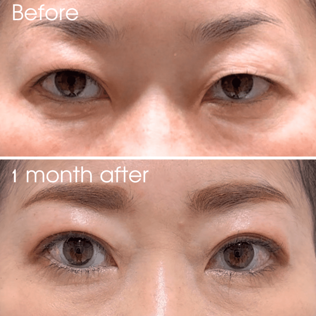 瞼が腫れぼったい！原因と治療法をタイプ別に解説！【医師監修】