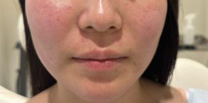 術前 貴族ヒアルとは？ほうれい線ヒアルとの違いを医師が解説！