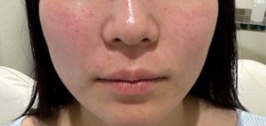 術後 貴族ヒアルとは？ほうれい線ヒアルとの違いを医師が解説！