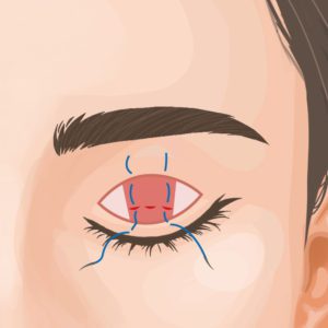 眼瞼下垂切開法のイメージ図。