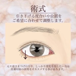 目の幅が狭いというお悩みの解決法として、グラマラスライン形成のイメージ。