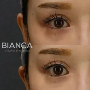 グラマラスライン形成症例