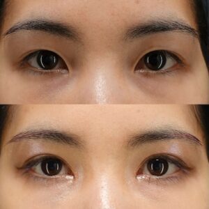 二重埋没×目頭切開の症例