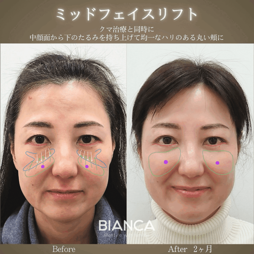 ELAICE フェイスリフト midfacelift-1024x1024.png