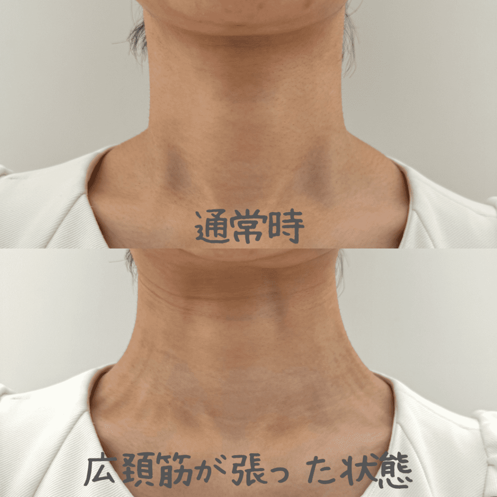 ボトックスリフトとは？首ボトックスでフェイスラインすっきり！【医師監修】