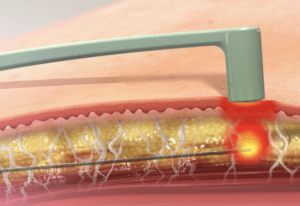 エンブレイスRFのダウンタイムは？切らずに引き上げる進化系たるみ治療を医師が解説【ビアンカクリニック】