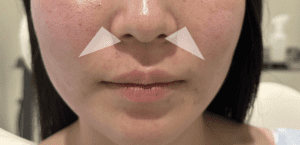 鼻翼基部 貴族ヒアルとは？ほうれい線ヒアルとの違いを医師が解説！