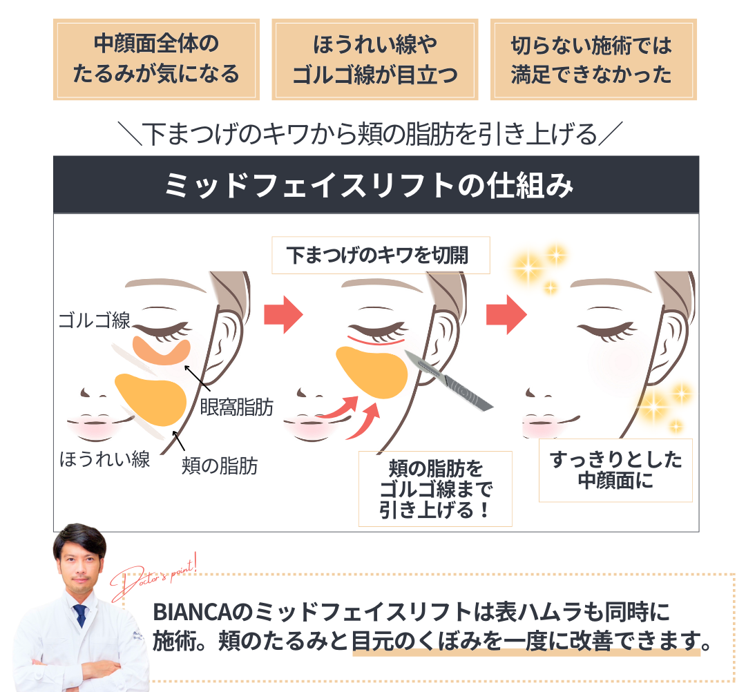 ミッドフェイスリフトとは