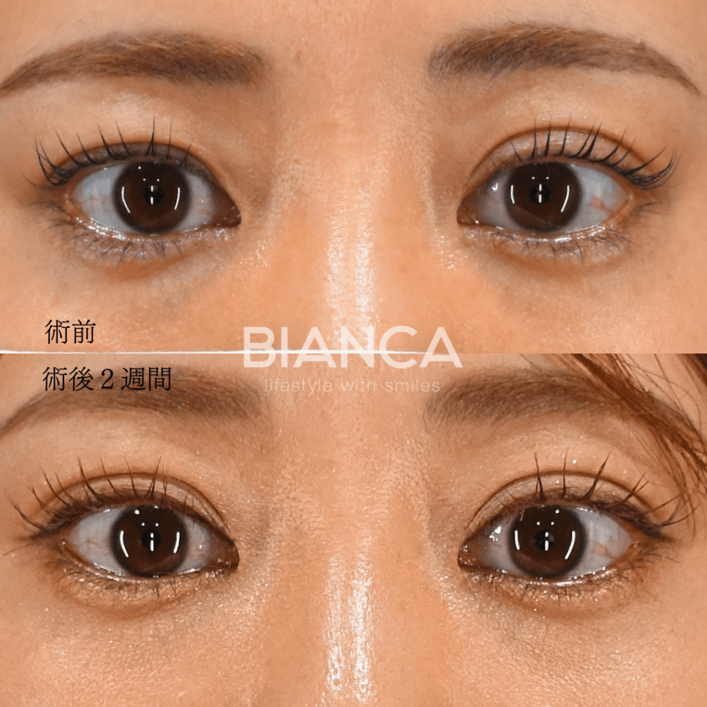 二重の左右差、どう直す？片目だけの埋没法という選択肢