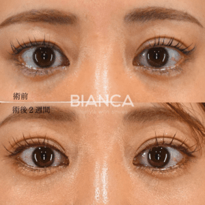 二重の左右差をなくすために行った二重埋没法症例写真