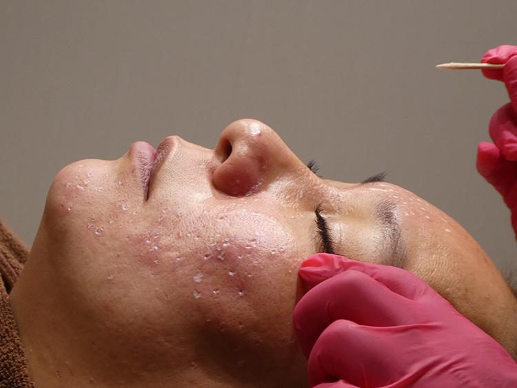 TCAクロス（クレーター治療）ビアンカ銀座｜日本を代表する美容健康再生医療のクリニック