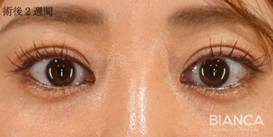 二重の左右差をなくすために行った二重埋没法症例写真