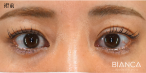 二重埋没の症例-池田雪太郎医師