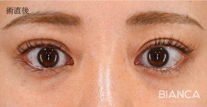 二重の左右差をなくすために行った二重埋没法症例写真