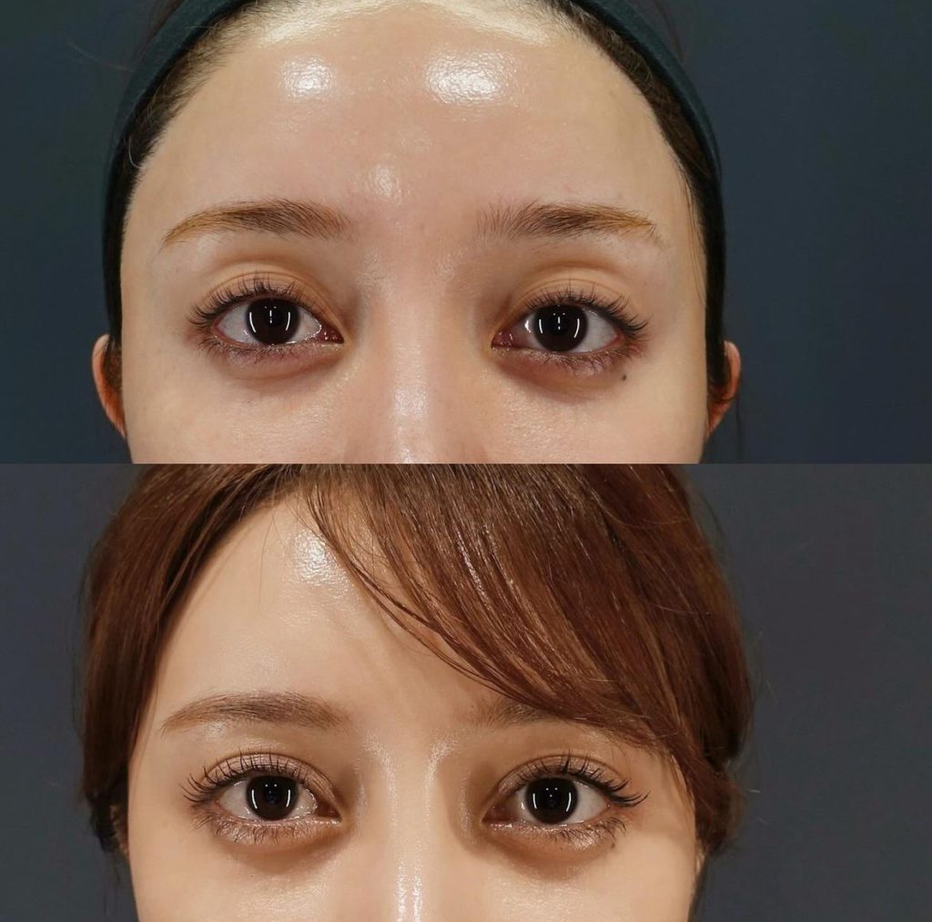 くぼみ目をヒアルロン酸で改善｜注入・手術の違いや適応を解説