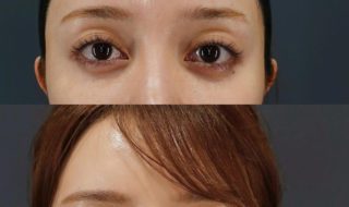 くぼみ目_上瞼ヒアルロン酸注射の症例