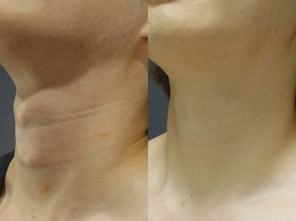 首のシワの原因とケア方法を徹底解説！縦ジワ・横ジワ・ちりめんジワが気になるあなたへ。