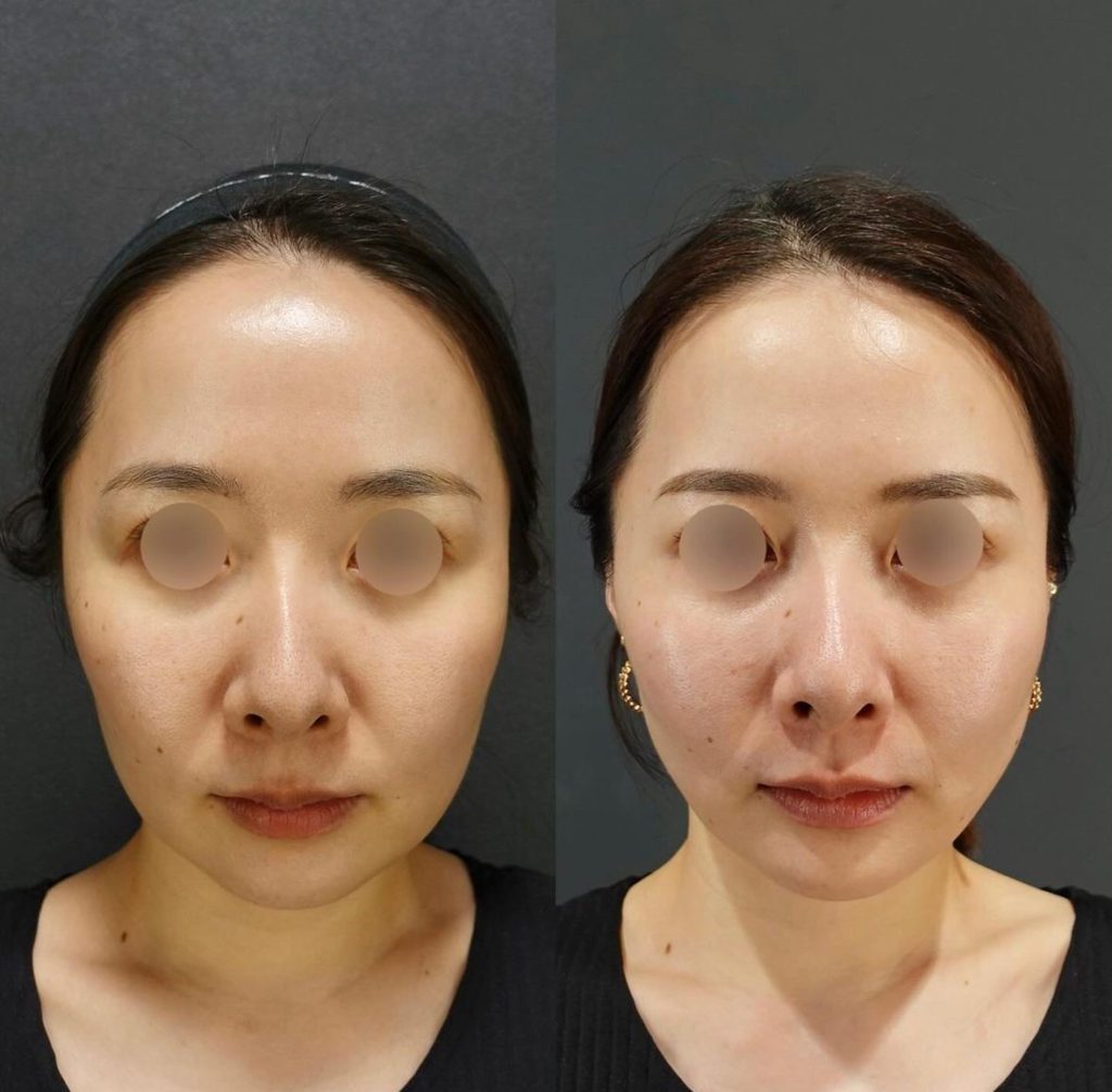 アルテミスリフトが注目を集める理由をビアンカドクターが解説！術後1ヶ月の経過は？