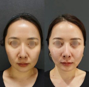 アルテミスリフトが注目を集める理由をビアンカドクターが解説！術後1ヶ月の経過は？