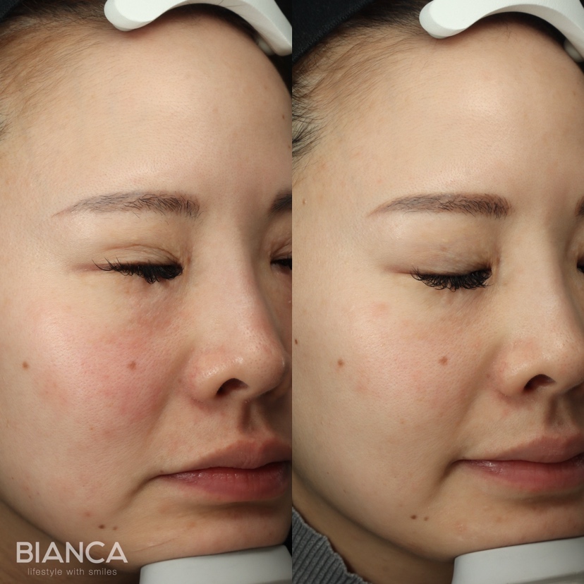 肌質改善の救世主！プルリアルデンシファイとは