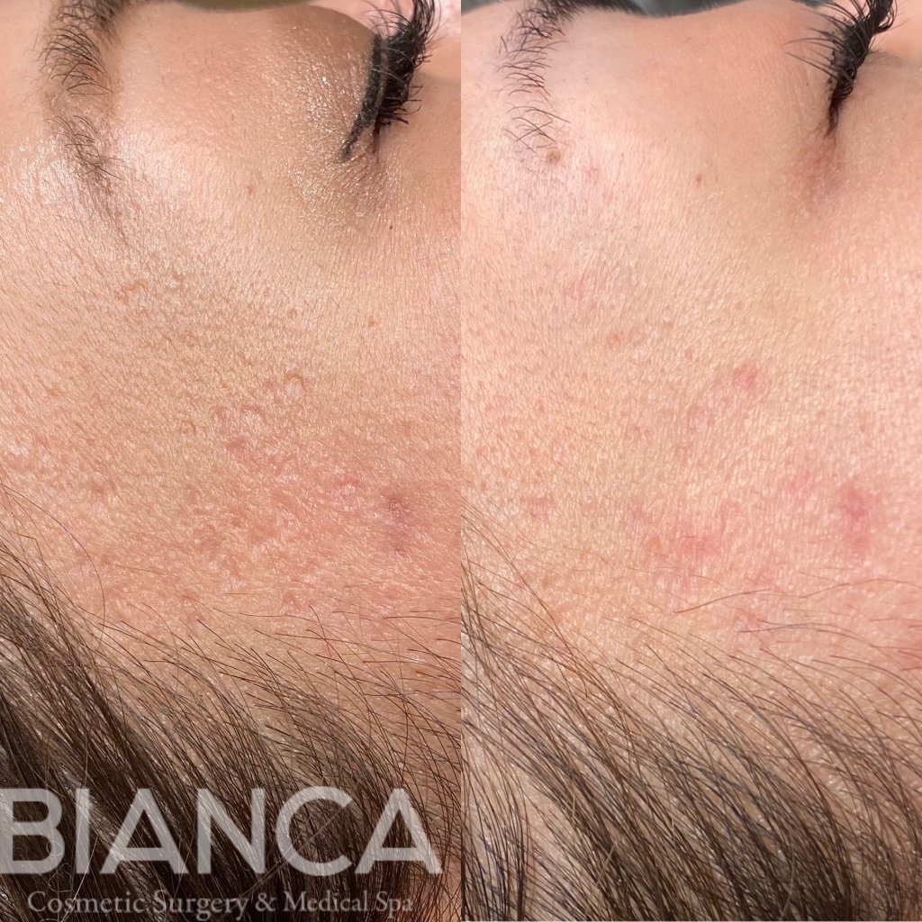 TCAクロスのダウンタイムはどれくらい？症例写真で経過を解説！