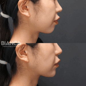 ヒアルロン酸注射症例-鼻・鼻筋・顎(エラ)