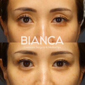 切らない眼瞼下垂 タッキング法_症例写真_ビアンカクリニック