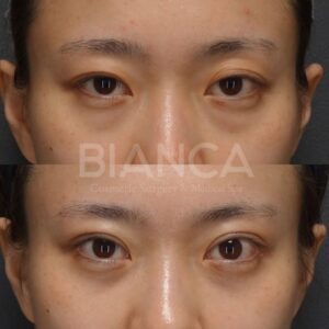 切らない眼瞼下垂_症例写真_ビアンカクリニック
