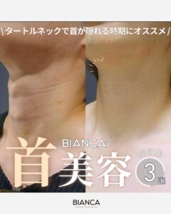 首のシワの原因とケア方法を徹底解説!縦ジワ・横ジワ・ちりめんジワが気になるあなたへ。