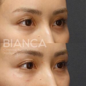 上瞼ヒアルロン酸注射_下瞼ヒアルロン酸注射_症例写真