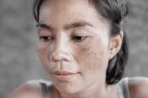 シミの種類と治療法を徹底解説！自分のシミに合ったケアを見つけよう