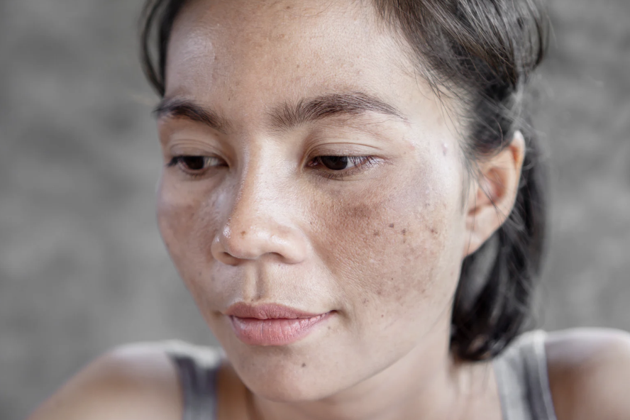 シミの種類と治療法を徹底解説！自分のシミに合ったケアを見つけよう