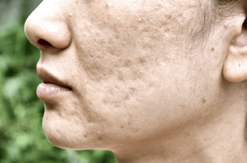 ニキビ跡治療完全ガイド｜クレーターだけじゃない！種類別の原因と先進の治療法を医師が解説