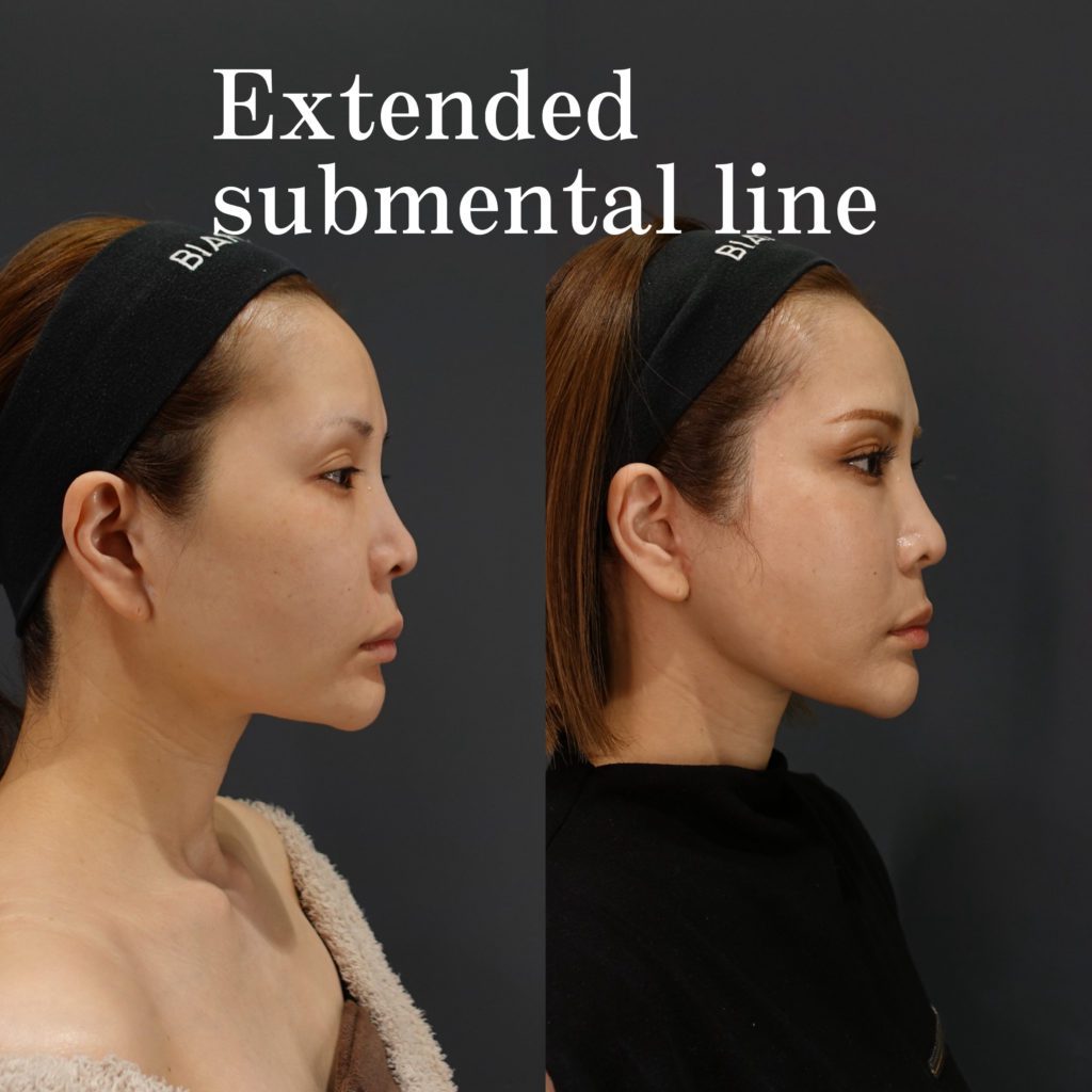 フェイスラインを作る