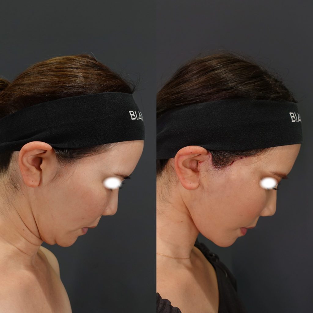 隠れタルミを撃退する②