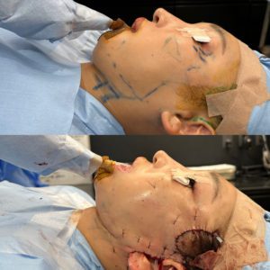 上：施術前、下：施術直後 【料金】ディーププレーンフェイスリフト 1,650,000円／ネックリフト 723,580円／麻酔 165,000円 【リスク】感染、血腫、創離開、顔面神経麻痺など 【ダウンタイム】腫れ、内出血など