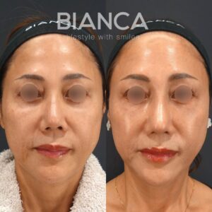 鼻中隔延長(耳介軟骨)✖鼻尖形成✖鼻プロテーゼ(特注) 術後3ヶ月