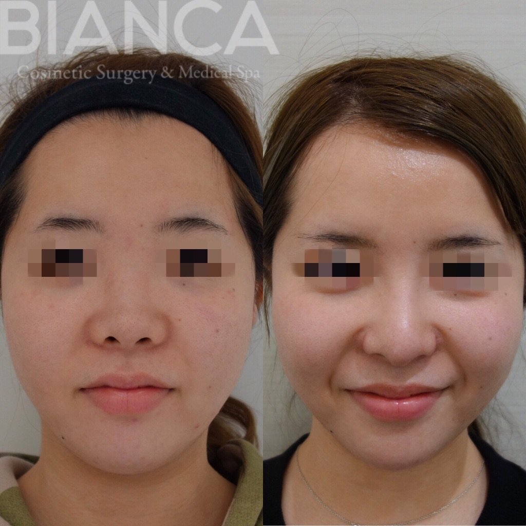 ACRとは？理想の鼻や横顔を決める重要な指標を医師が解説